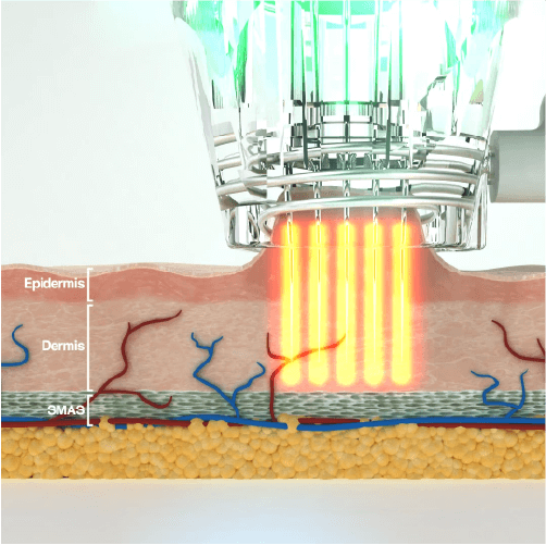 Focus Dual - RF Microneedling
